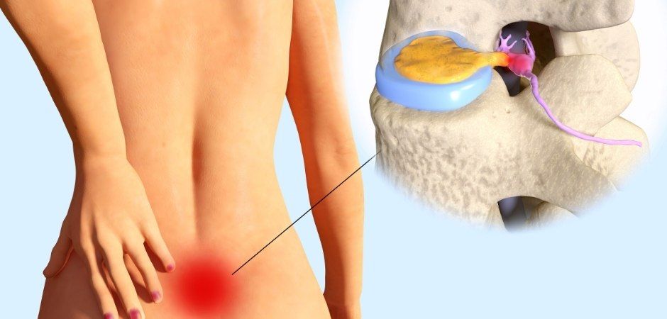hernia discal lumbar